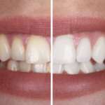 Sbiancamento dentale: sembra funzionare bene anche l’idrossiapatite