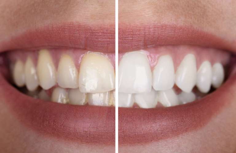 Sbiancamento dentale: sembra funzionare bene anche l’idrossiapatite