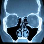 Patologia del seno mascellare, le implicazioni odontoiatriche