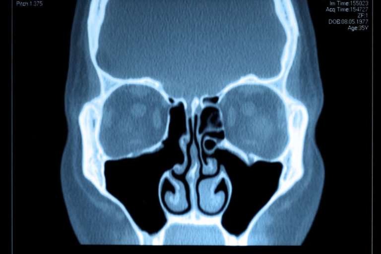 Patologia del seno mascellare, le implicazioni odontoiatriche