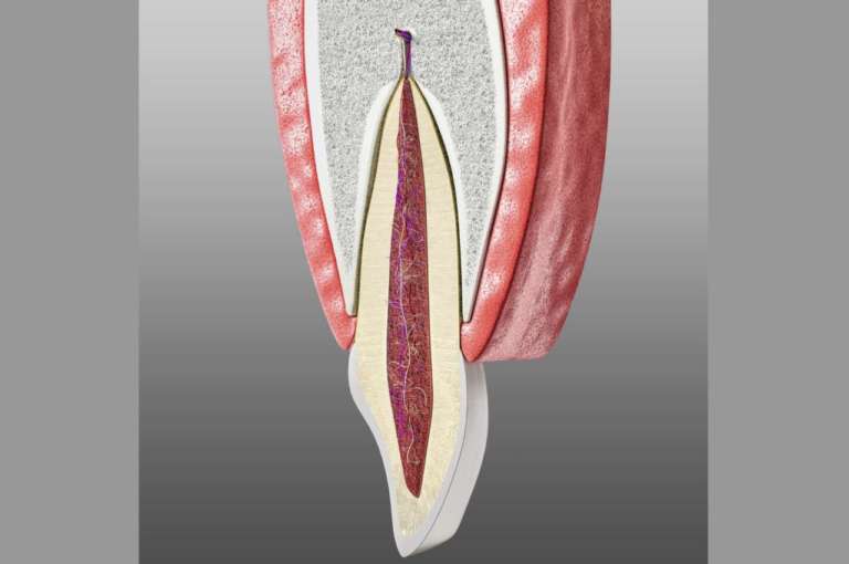 Rigenerazione ossea verticale e possibili complicanze