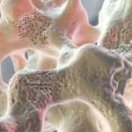 L’osteoporosi non mette a rischio gli impianti dentali