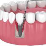 Perimplantite, quanto è efficace la cura di supporto dopo la terapia perimplantite