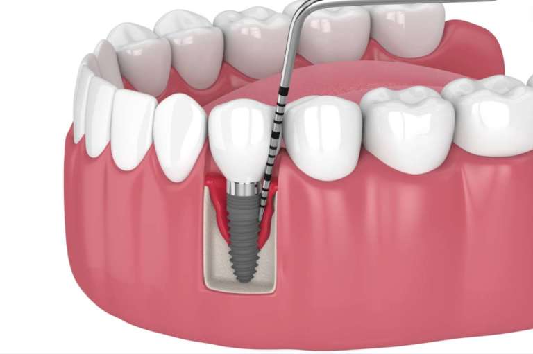 Perimplantite, quanto è efficace la cura di supporto dopo la terapia