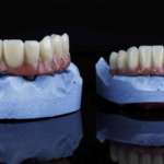 Protesi fisse full-arch, come evitare l’accumulo di placca