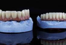 Protesi fisse full-arch, come evitare l’accumulo di placca