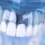 Osteointegrazione dell’impianto, quanto conta la velocità di trapanatura