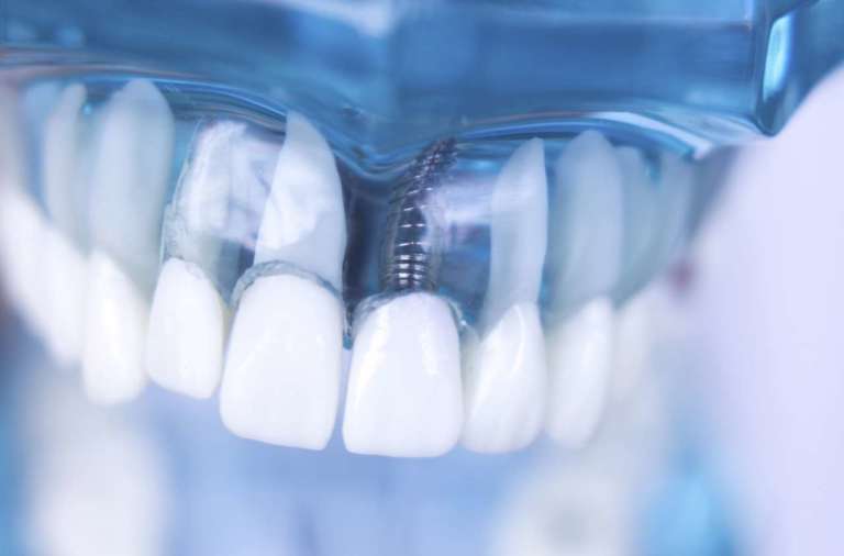 Osteointegrazione dell’impianto, quanto conta la velocità di trapanatura