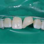 Resmile template mode: case report