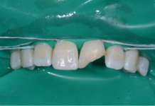 Resmile template mode: case report