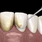 Parodontite, allo studio un nuovo strumento per diagnosticarla Parodontite