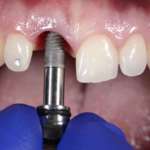 La pellicola salivare condiziona il biofilm sulle superfici in titanio