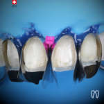 La matrice come chiave del successo nei restauri anteriori diretti: Unica anterior di Polydentia Unica anterior di Polydentia