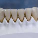 Zirconia monolitica e zirconia rivestita a confronto