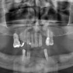 Approccio multidisciplinare in un caso di atrofia ossea combinata