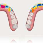 Invisalign Smile Architect™: il cambio di paradigma nei piani di trattamento integrati orto-restaurativi con Invisalign Go™