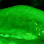 Il lichen planus: malattia orale potenzialmente maligna