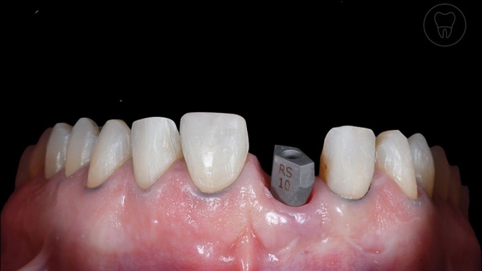 Invisalign Smile Architect™