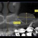 Rimozione atraumatica di pseudocisti antrale con rialzo di seno mascellare: case report