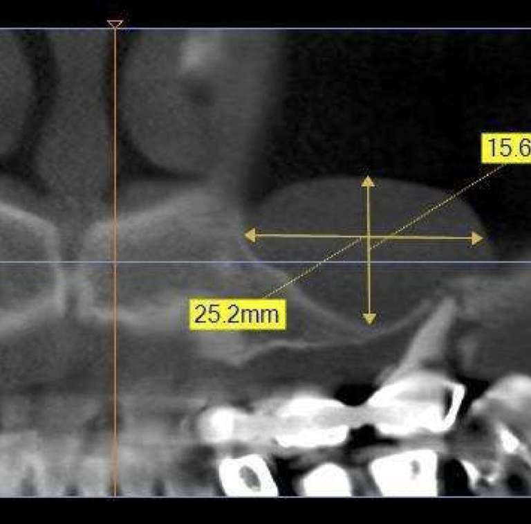 Rimozione atraumatica di pseudocisti antrale con rialzo di seno mascellare: case report