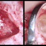 Micro-Endodonzia chirurgica di 1.5 in presenza di calcificazioni