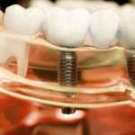 Implantologia flapless, i vantaggi descritti in uno studio