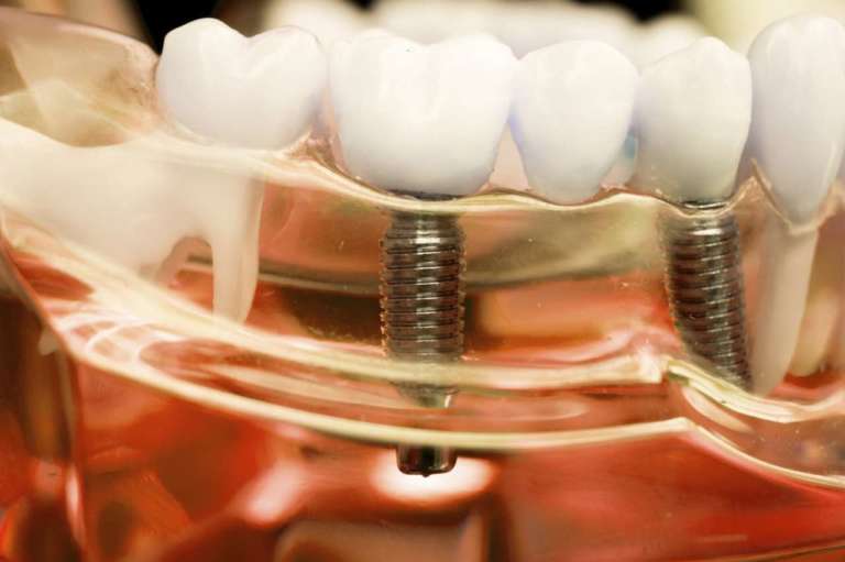 Implantologia flapless, i vantaggi descritti in uno studio