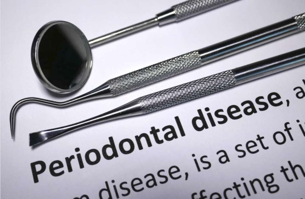 parodontite