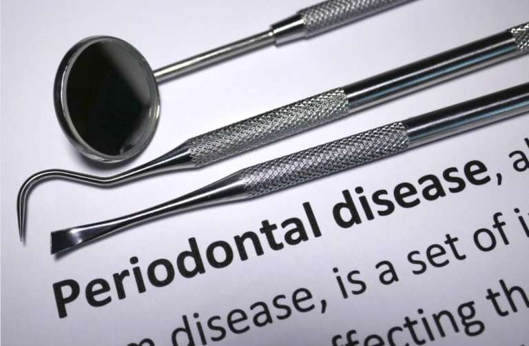 Parodontite apicale e malattie autoimmuni, quando serve lo screening