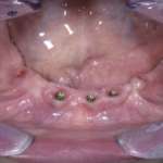 Plain B-Space: tutti i benefici della convergenza, oggi anche su impianti bone level Plain B-Space