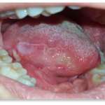 Trattamento di lesioni orali erosive bilaterali di tipo simil-lichenoide con olio ozonizzato