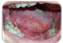 Trattamento di lesioni orali erosive bilaterali di tipo simil-lichenoide con olio ozonizzato