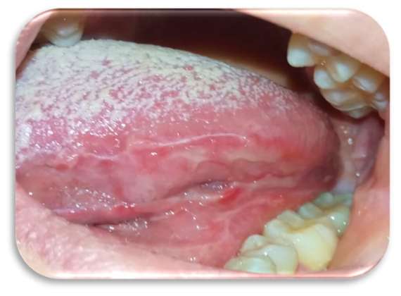 lesioni orali olio ozonizzato