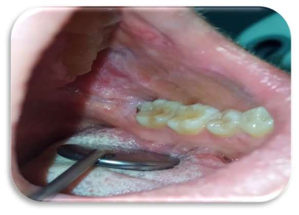 lesioni orali olio ozonizzato