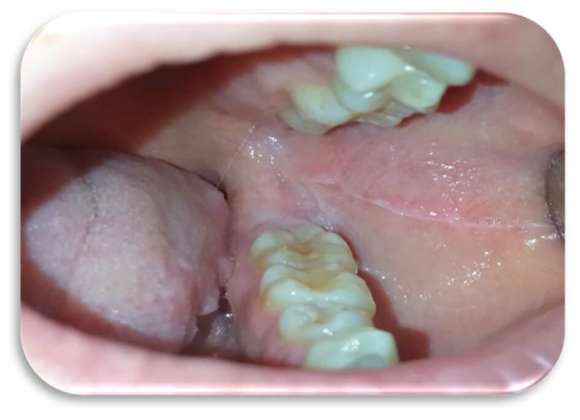 lesioni orali olio ozonizzato