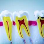 Canali radicolari a forma di “C”, con le GAN sono più chiari