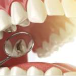 Carie, i metodi di rimozione chimico-meccanica sono il futuro