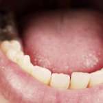 Carie dentale, l’approccio più adatto per gestirla al meglio