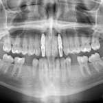 Chirurgia guidata: riabilitazione implanto protesica di agenesia degli incisivi laterali superiori Chirurgia guidata