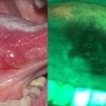 I metodi di ausilio ottico utili per l’anticipazione della diagnosi di cancro orale