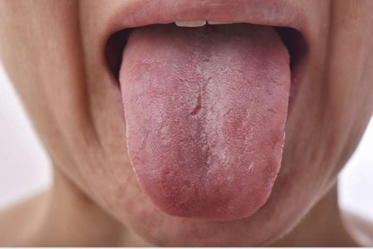 Chemioterapia e mucosite, la fotobiomodulazione la previene