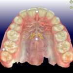 Risposta biomeccanica del primo molare superiore sottoposto a carico masticatorio in differenti condizioni di intercuspidazione