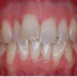 Gestione ortodontico-parodontale di un caso trattato con allineatori Orthocaps