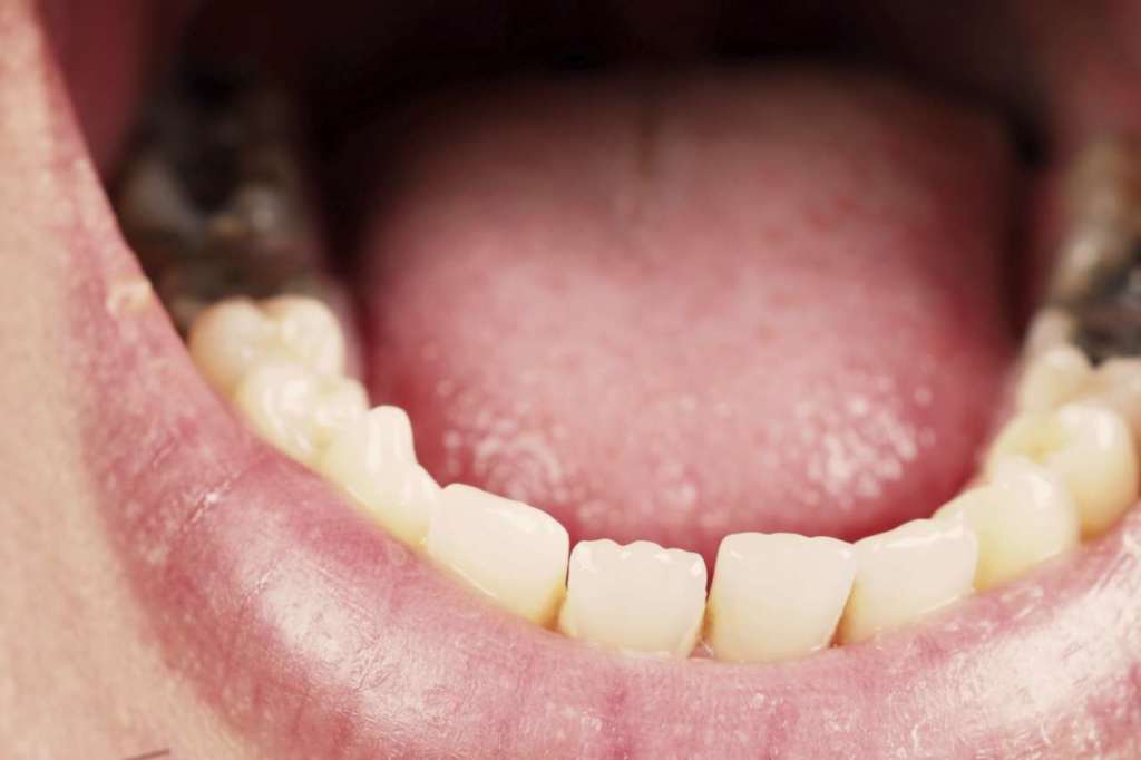 carie materiali attivi