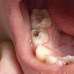 Cariologia: cresce l’interesse per le “tecnologie omiche” cariologia omiche