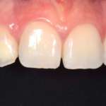 White spot: i trattamenti più efficaci per renderle meno visibili