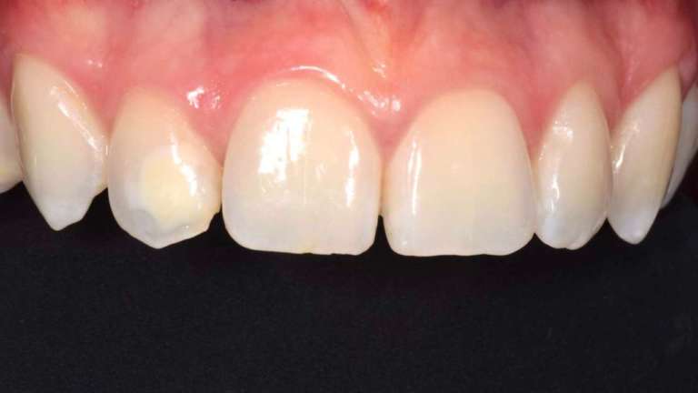 White spot: i trattamenti più efficaci per renderle meno visibili