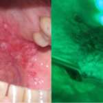 Cancro orale: il ruolo dell’igienista dentale cancro orale