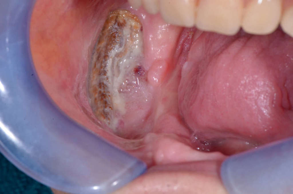 osteonecrosi mascellari