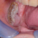 Osteonecrosi delle ossa mascellari farmaco relata: conoscerla per prevenirla osteonecrosi mascellari